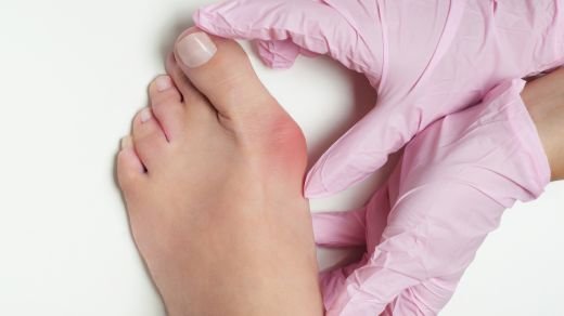 Celebrities and Their Battle with Bunions: The Painful Reality Beneath the Glamour